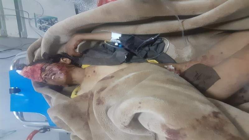 Six Children Injured in Cluster Bomb Explosion of US-Saudi Aggression Remnants, Hajjah