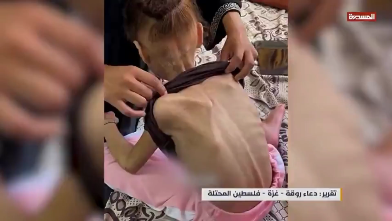 Wheat Allergy Patients in - Gaza Face Life-Threatening Risks