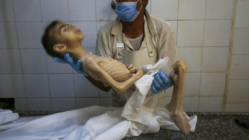 Gaza Death Toll from Famine Rises to 453, Including 150 Children